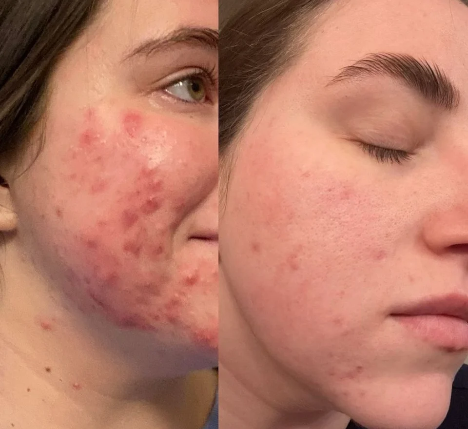 Aerolase laser acne before and after at Revive Beauty Bar
